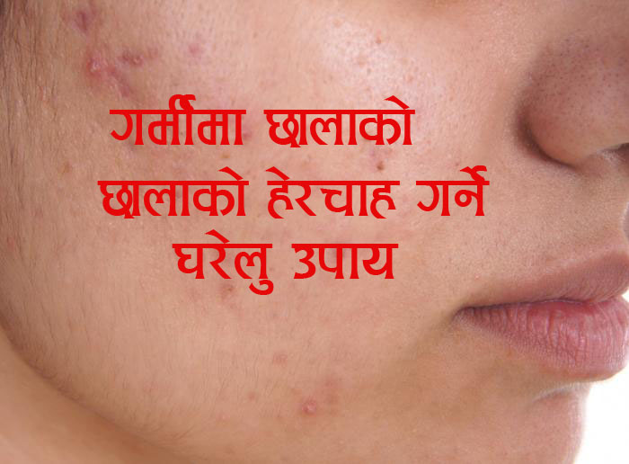 गर्मीमा छालाको सुरक्षा कसरी गर्ने ? भिडियो सहितको टिप्स यस्तो छ ।