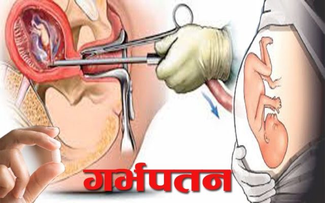 1 वर्षमा ९७२ ले गराए गर्भपतन