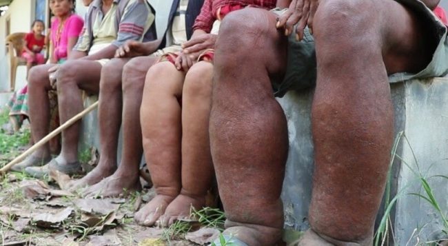 नेपालगञ्ज समाचारः ‘हात्ती पाइलेविरुद्धको औषधि निर्धक्क सेवन गरौंँ’