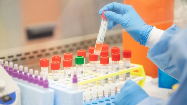 ल्याबैपिच्छे किन कोरोनाको फरक रिपोर्ट ?